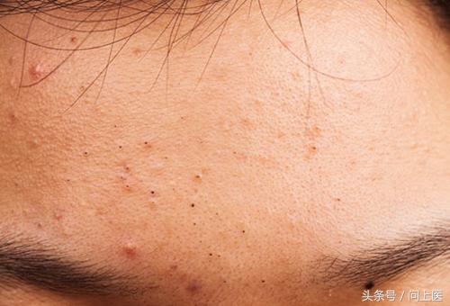 类固醇类药物有哪些危害,类固醇类药物治疗什么病