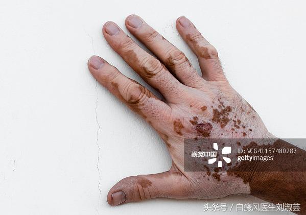 食疗：辅助治疗白癜风，增强抵抗力，促进黑色素细胞活性