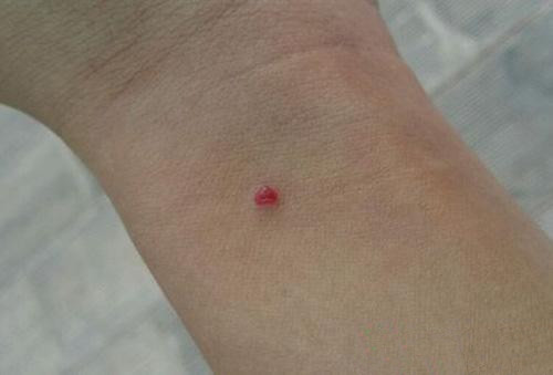 慢性肝病红点,肝病引起的小红痣如何去除