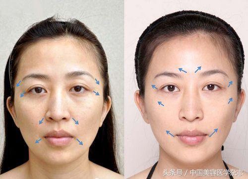 超声刀可以除皱吗,超声刀后脸部肿胀怎么办