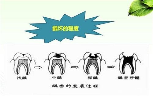 心疼龋齿宝宝——看口腔科比看感冒还多的漫漫看牙路