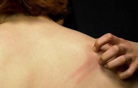 过敏湿疹速效止痒,皮肤过敏湿疹用什么中药处方