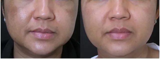 脸上突然出现很多褐斑,脸上褐斑的最好治疗方案