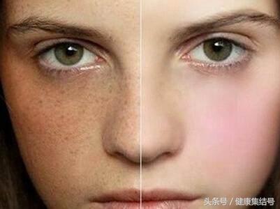 色斑的预防和治疗快速去除色斑,色斑的原因及治疗方法