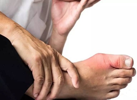 盘点缓解痛风发作疼痛的十大方法，服用秋水仙碱只是其中之一！