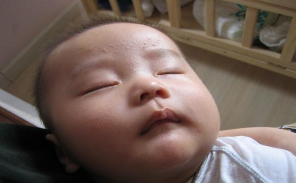 如何预防宝宝夏天长痱子,秋季痱子怎么快速消除