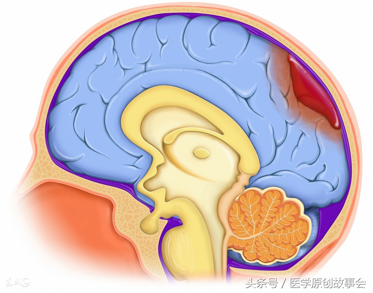 31岁男子熬夜打麻将致小脑梗死,男子打麻将突发脑梗
