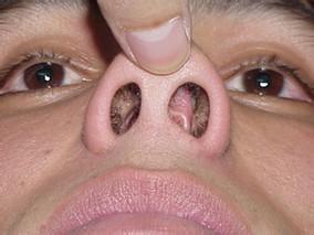 得了鼻炎偏方,得了鼻炎千万不要再乱用药了