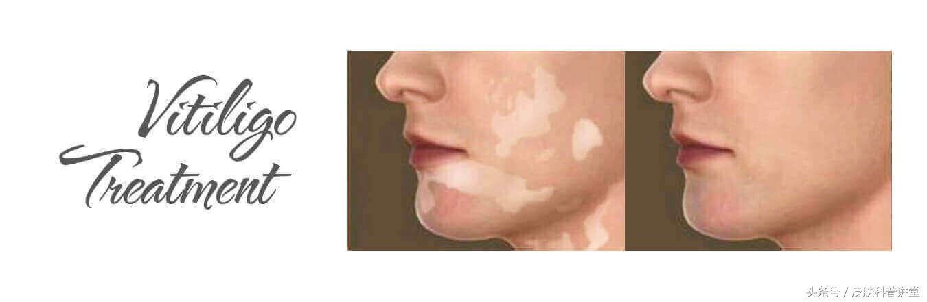 白癜风最新治疗方法录音,白癜风的治疗新进展