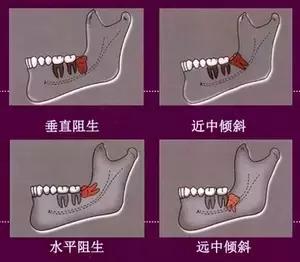 智齿导致旁边牙齿龋齿,智齿有龋齿有必要修补吗