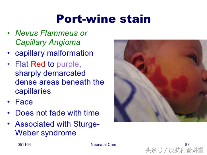 冷冻可以治疗鲜红斑痣胎记吗,治疗鲜红斑痣胎记的方法有哪些