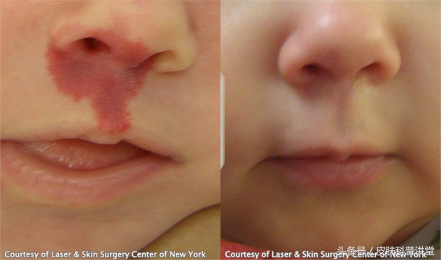 鲜红斑痣和新生儿红胎记区别,激光染料治疗网状鲜红斑痣的效果