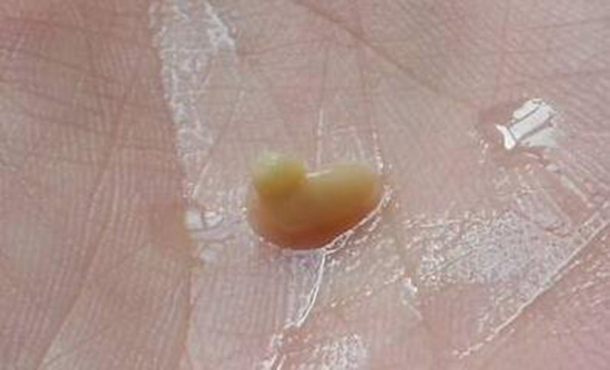 总感觉喉咙里面有东西抠不出来,嗓子有异物感还咳出石头