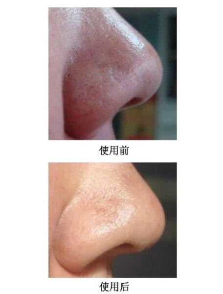 怎么收缩毛孔去除黑头小妙招,去黑头怎么收缩毛孔小妙招