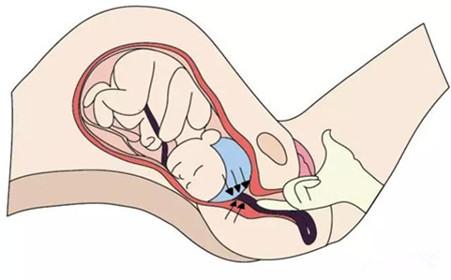 胎儿头先露需要注意什么,胎儿脐带先露是怎么回事