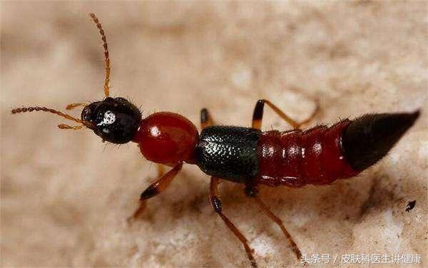 脖子上出现疱疹是怎么回事,前胸起一个红疙瘩是带状疱疹吗