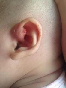 先天性耳前瘘管切除手术多少钱,先天性耳瘘代表聪明吗