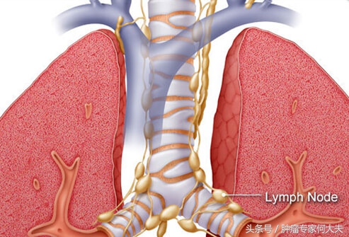 初期肺癌喝中药能消除吗,早期肺癌可以喝中药治愈吗