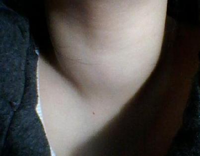 甲减患者会出现精神抑郁是真的吗,甲减为什么容易抑郁