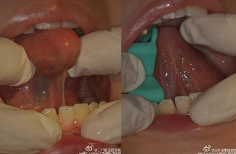 家长带孩子看舌系带,孩子舌系带短需要切除吗