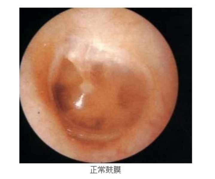 鼓膜挫伤听力下降,鼓膜外伤怎么处理