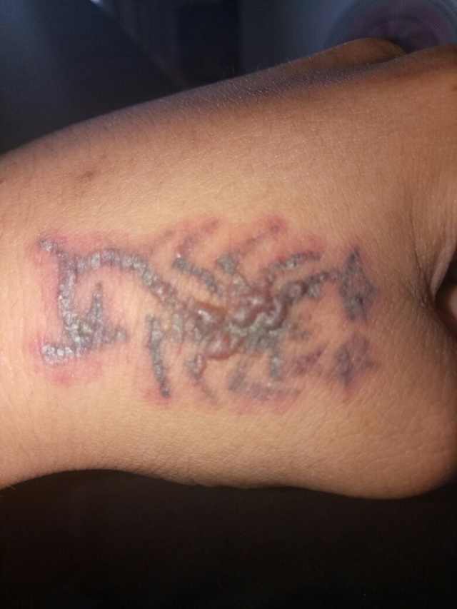 激光洗纹身需要修复吗,纹身后悔了怎么办啊