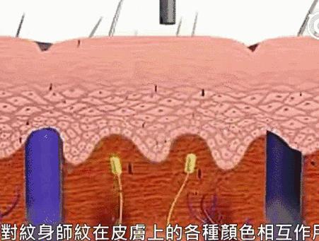 激光洗纹身需要修复吗,纹身后悔了怎么办啊