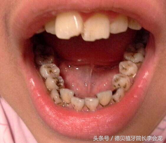 牙齿不齐矫正牙齿的最佳年龄,牙齿排列不齐有必要矫正吗