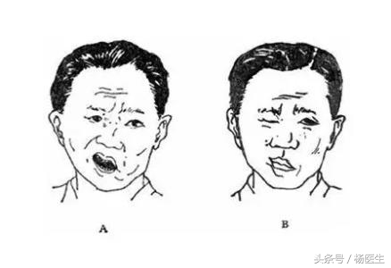 年轻人会得面瘫吗,年轻人也会中风吗中风会致死吗