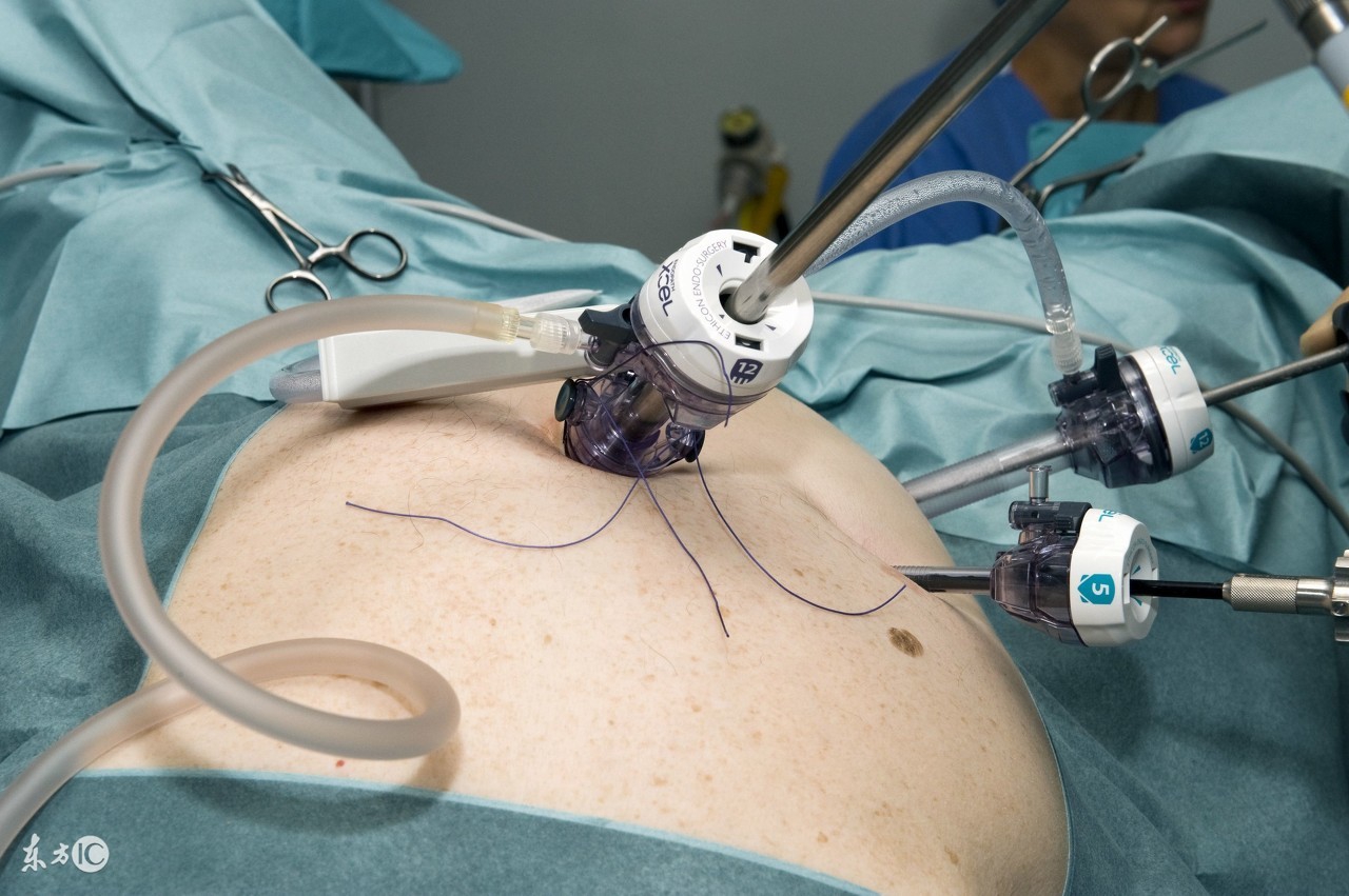 腹腔镜输卵管手术后怎么备孕,输卵管腹腔镜手术成功怀孕实例