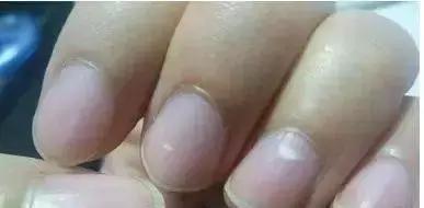 指甲竖纹变少了,指甲竖纹发白没血色