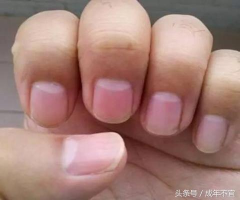 手指半月牙正常图片,手指没有半月牙是怎么回事