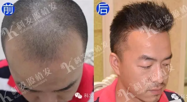 植发必须取后枕部的毛囊吗,植发提取毛囊的部位还能长头发吗