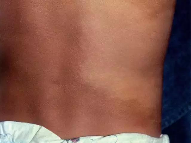 胎记及早治疗,胎记不治有什么后果