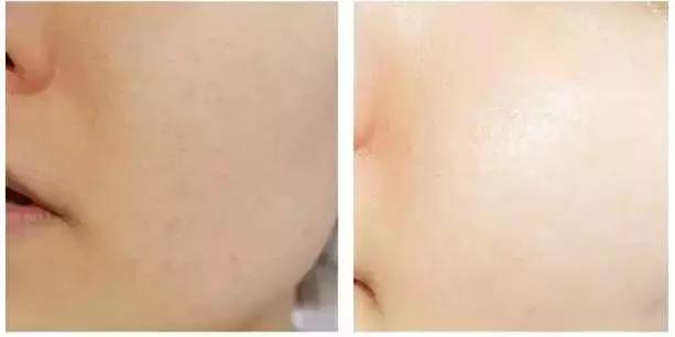 敷面膜后加什么保养效果最好,换季皮肤起皮好用的修复补水面膜