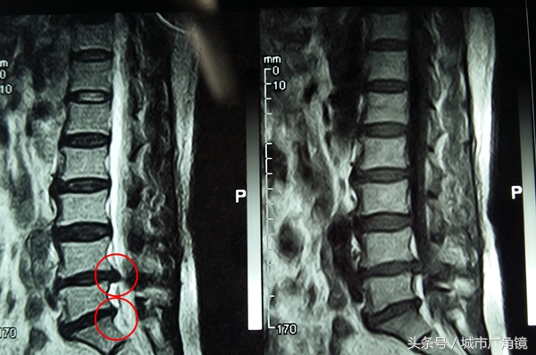 福音医院治疗腰椎间盘突出厉害不,严重的腰椎间盘突出中医怎么治