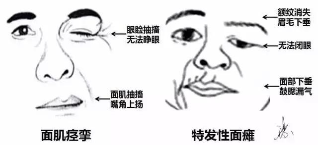 面瘫专家在线问诊,专家专治面瘫视频