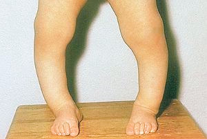 早产儿补充维生素ad的时间及用量,补充维生素Ad有什么好处