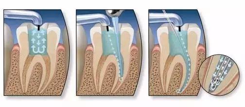 牙齿被判了死刑，就真的没救了