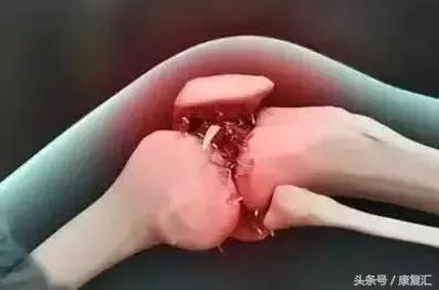 骨刺其实不是病千万不要过度治疗,骨刺真的就如你想象一般可怕吗