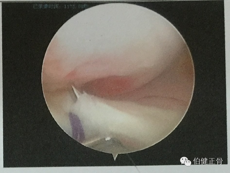 关节内外、经骨骺/不经骨骺单隧道纽扣技术治疗小儿前交叉韧带止点撕脱骨折经验介绍