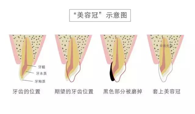 一周快速脸部美白小妙招,美容冠的形态怎么做的