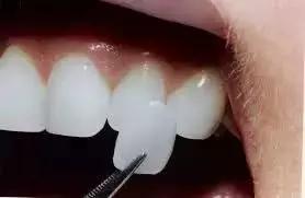 明星做的牙齿贴面,明星做的牙贴面都是什么材质