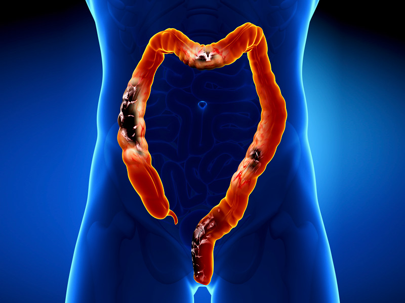 长期便秘突然排便顺畅警惕肠癌,长期便秘是肠癌的前兆