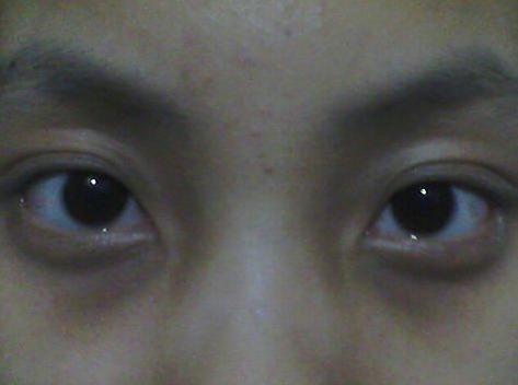 黑眼圈眼袋消除,黑眼圈眼袋消除小偏方视频