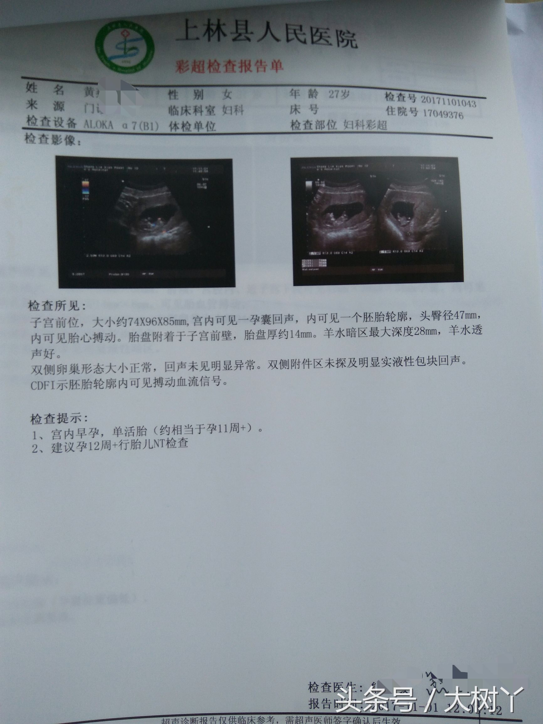 保胎过程中孕酮hcg还降了,孕酮低保胎真实感受