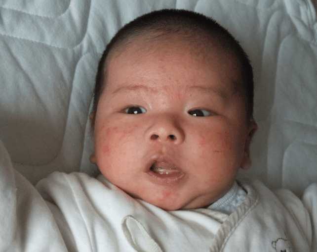 3个月的小宝宝容易长湿疹,刚出生宝宝一脸湿疹