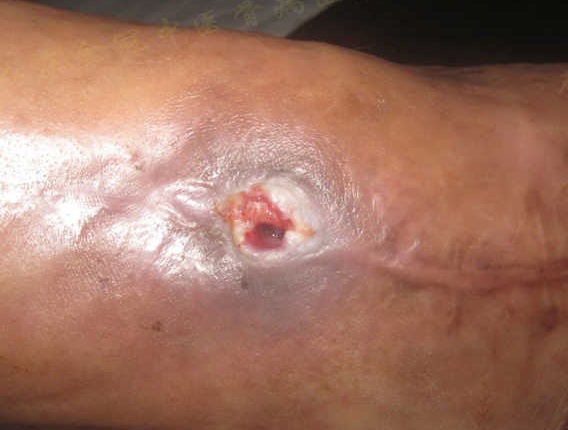 治疗骨髓炎中医高手,骨髓炎怎么彻底治疗