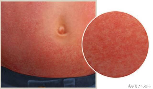 扁桃体炎有小红疹吗,扁桃体炎化脓会导致荨麻疹吗