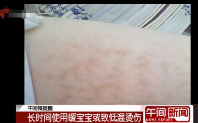 宝宝怎么防冻伤,宝宝烫伤天气热怎么护理